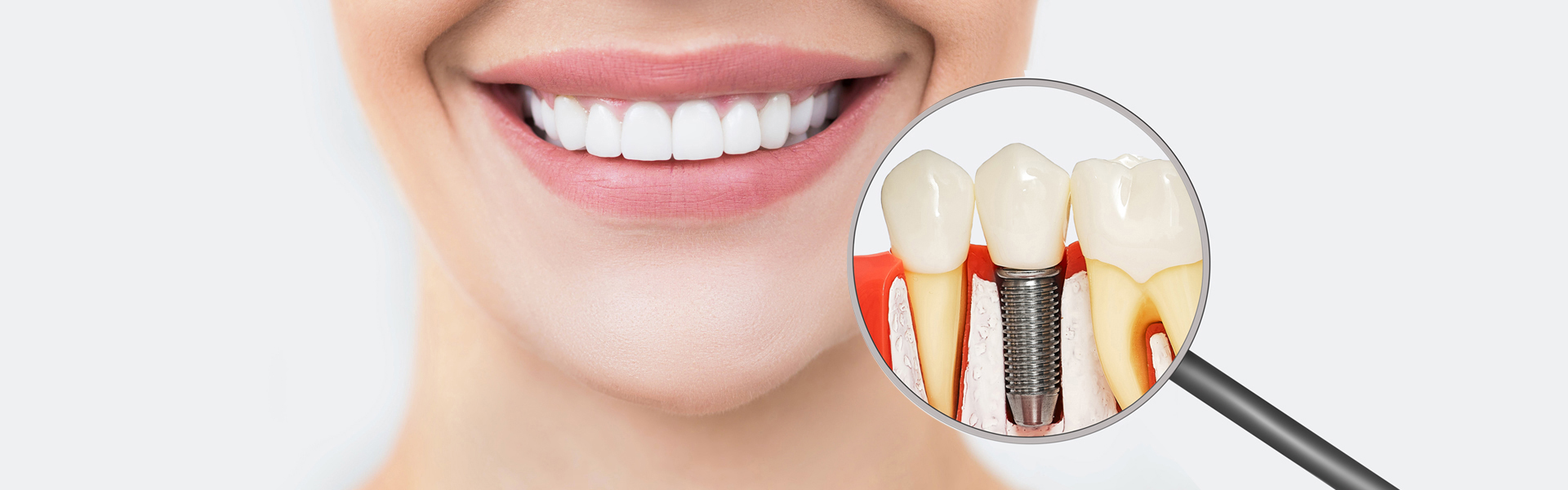 What Causes Someone to Need Dental Implants?