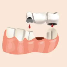 How Dental Bridges Improve Chewing, Speech & Confidence in Lapeer, MI?
