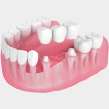 Types of Dental Bridges Available in Lapeer, MI, and Which One Is Right for You?