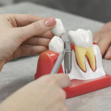 Step-by-Step Guide: What to Expect During a Dental Implant Procedure